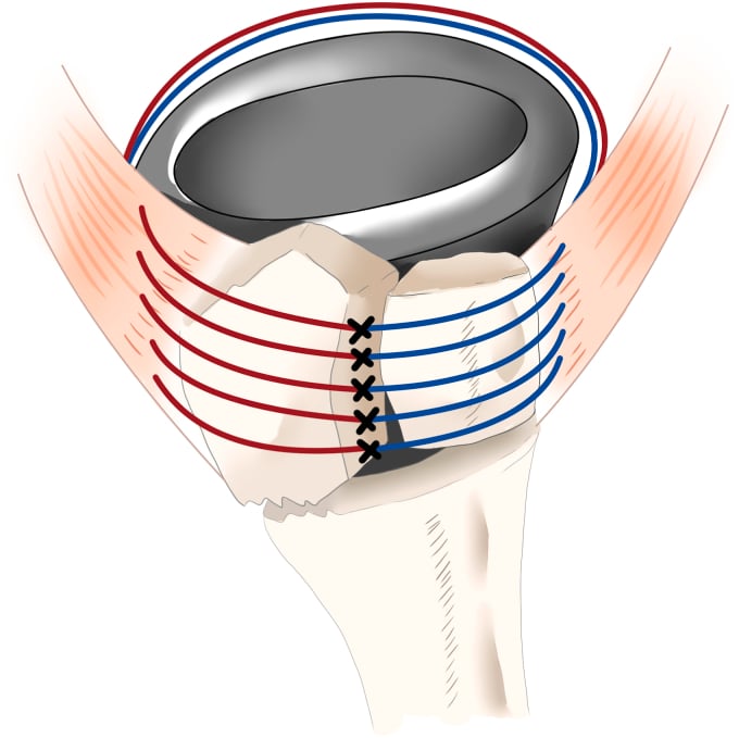 Diagram of a turned-stem tension band suture construct securing the tuberosities to the prosthesis and shaft