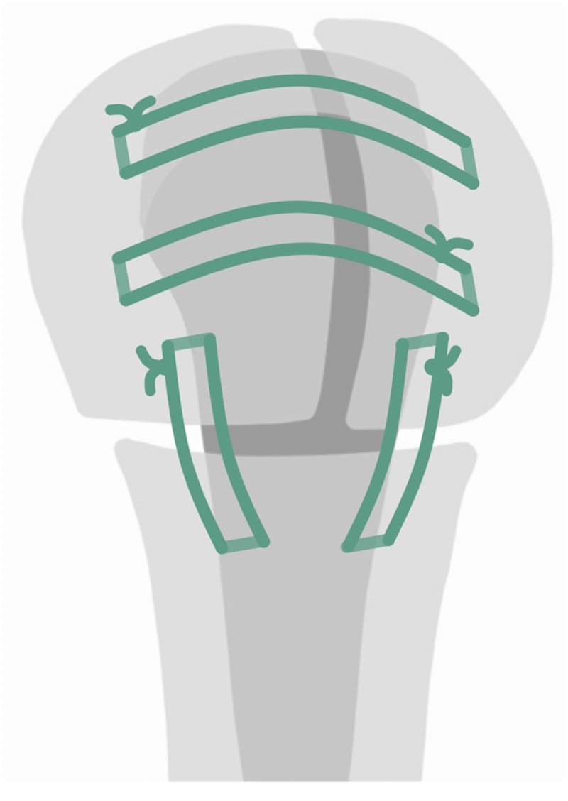Schematic of the tuberosity fixation construct with horizontal cerclage and vertical sutures around a humeral stem