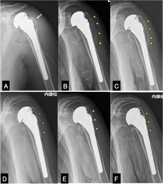 Serial radiographs from intraoperative reduction through one year showing greater tuberosity position and union