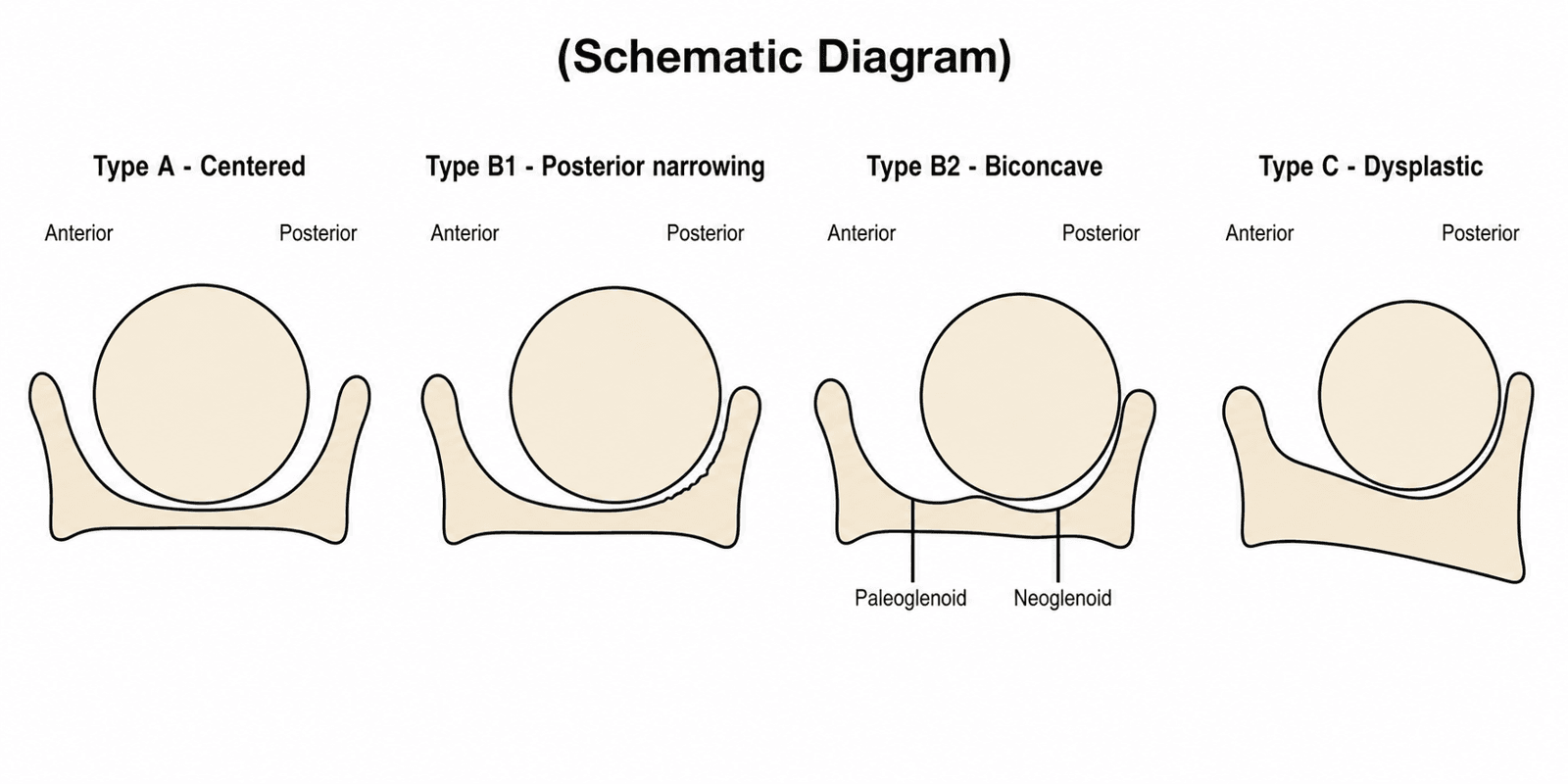 Schematic diagram of the Walch glenoid classification showing Type A centered, Type B1 posterior narrowing, Type B2 biconcave with paleoglenoid and neoglenoid, and Type C dysplastic glenoid