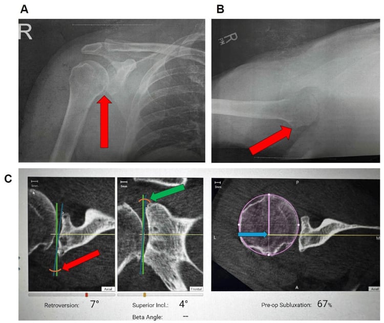 Primary shoulder OA radiographs with CT measurements of glenoid version and posterior subluxation