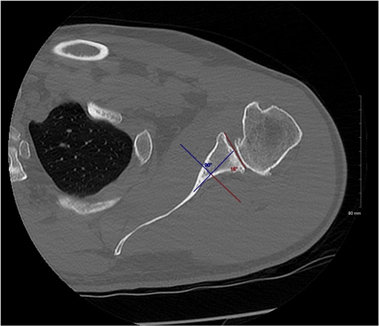Glenoid-vault method for measuring version on the same axial CT