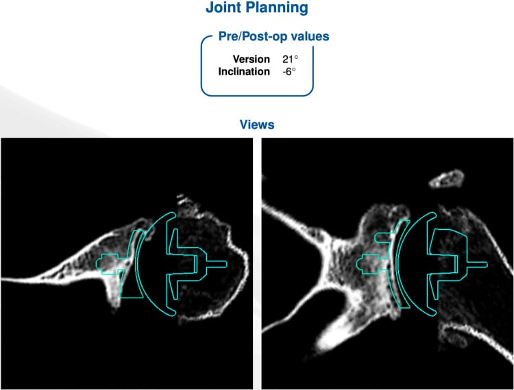 CT planning views templating an augmented glenoid component and humeral component