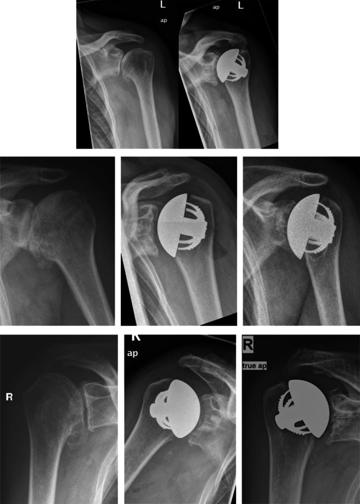 Preoperative early postoperative and long-term radiographs after stemless shoulder arthroplasty