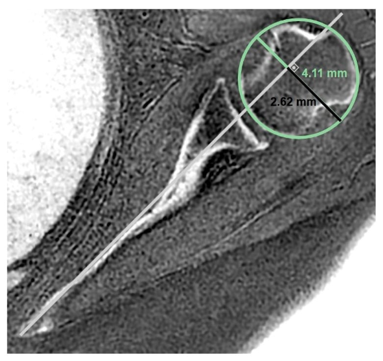 Best-fit humeral-head circle referenced to the scapular-axis line to measure posterior humeral-head subluxation