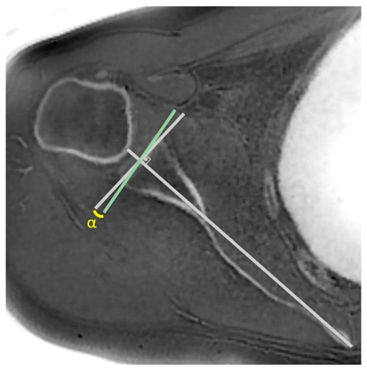 Glenoid version measurement with angle alpha between the glenoid face and the perpendicular to the scapular axis