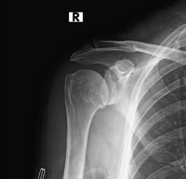 AP radiograph showing primary glenohumeral osteoarthritis before arthroplasty