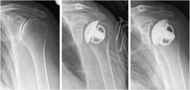 Primary OA before and after stemless anatomic shoulder arthroplasty