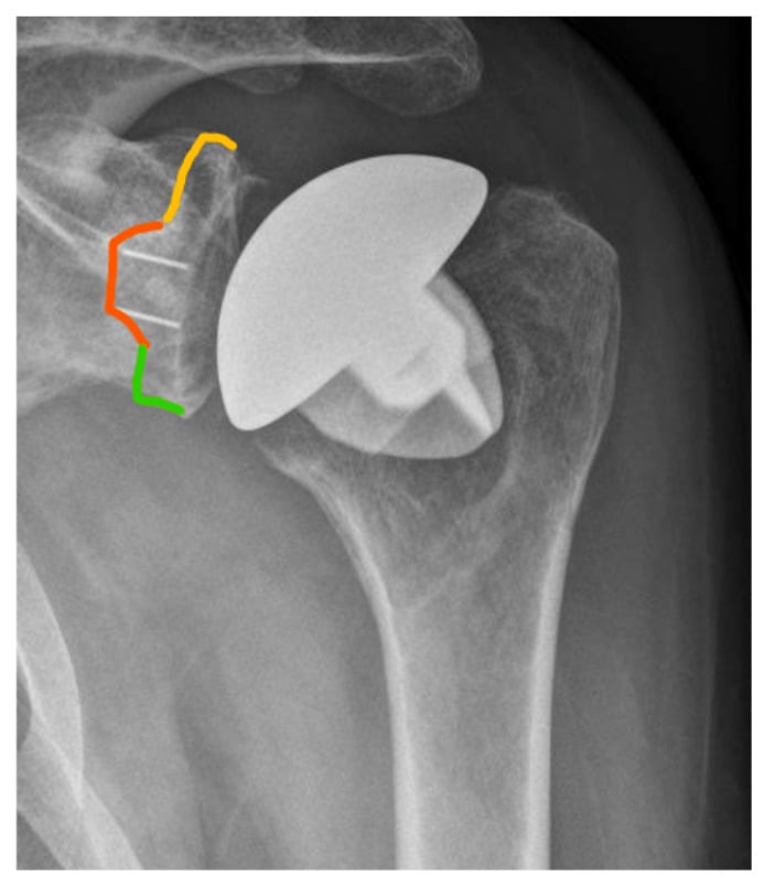 Radiolucent lines around a glenoid component divided into superior medial and inferior thirds