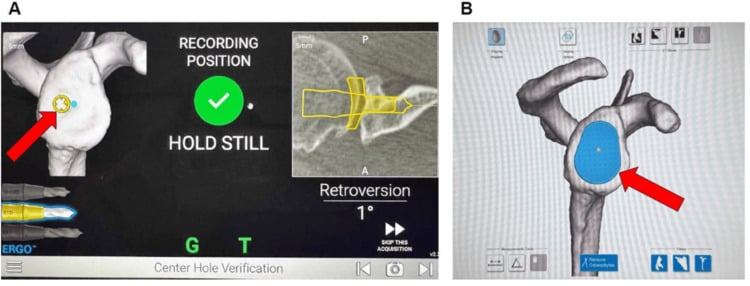 Navigation screens showing centre-hole verification at 1 degree of retroversion and the registered glenoid surface