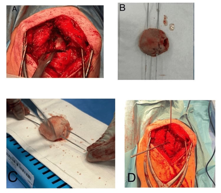 Humeral-head autograft preparation for severe glenoid bone loss in reverse arthroplasty