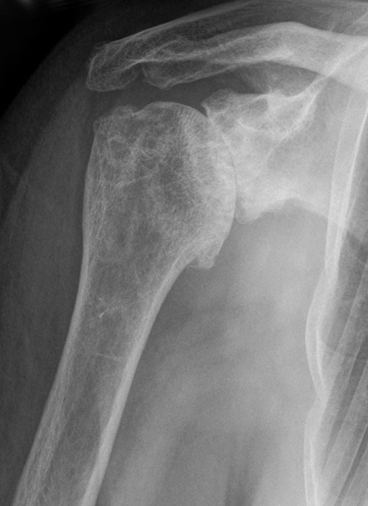 AP shoulder radiograph of glenohumeral osteoarthritis with joint-space narrowing and an inferior humeral-head osteophyte.