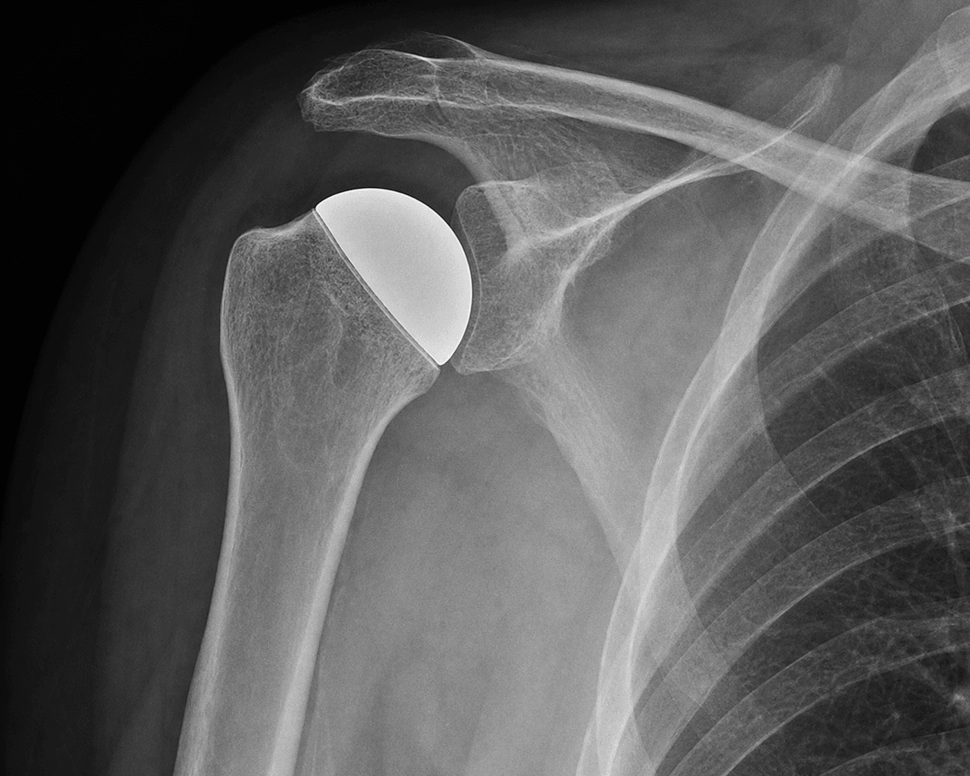 AP shoulder radiograph after humeral head resurfacing showing a cap over the humeral head with no stem