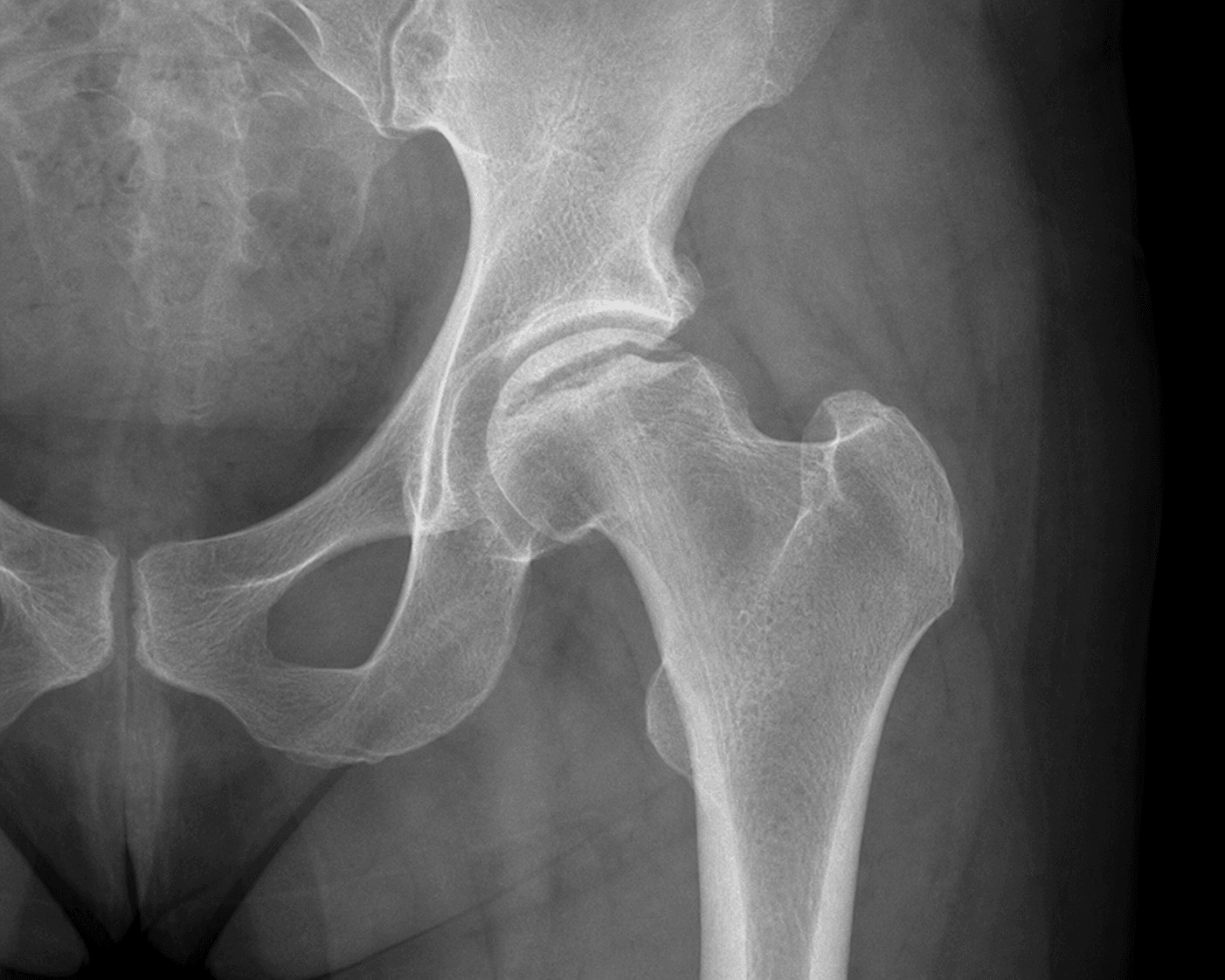 AP radiograph of the hip showing the femoral head, the site commonly assessed for osteonecrosis in sickle cell disease.