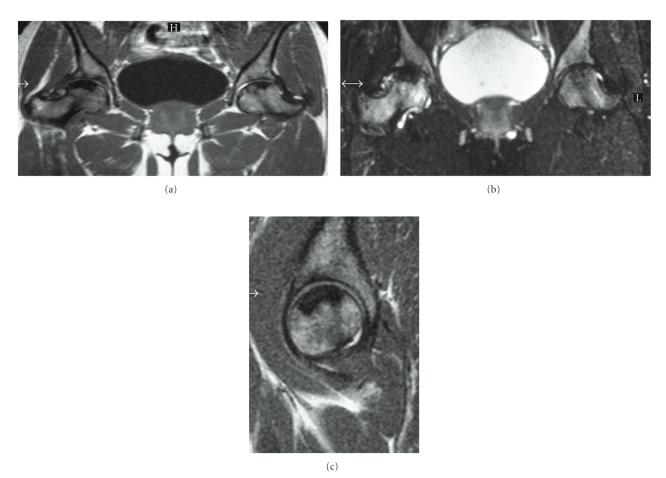 MRI showing advanced bilateral femoral-head osteonecrosis in sickle cell anaemia