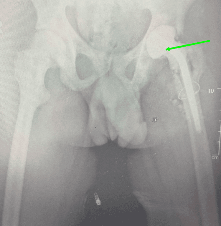 Antibiotic-loaded hip spacer after debridement of infected sickle-cell osteonecrosis