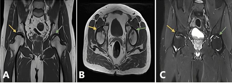 MRI comparison of pre-collapse and collapsed femoral-head osteonecrosis