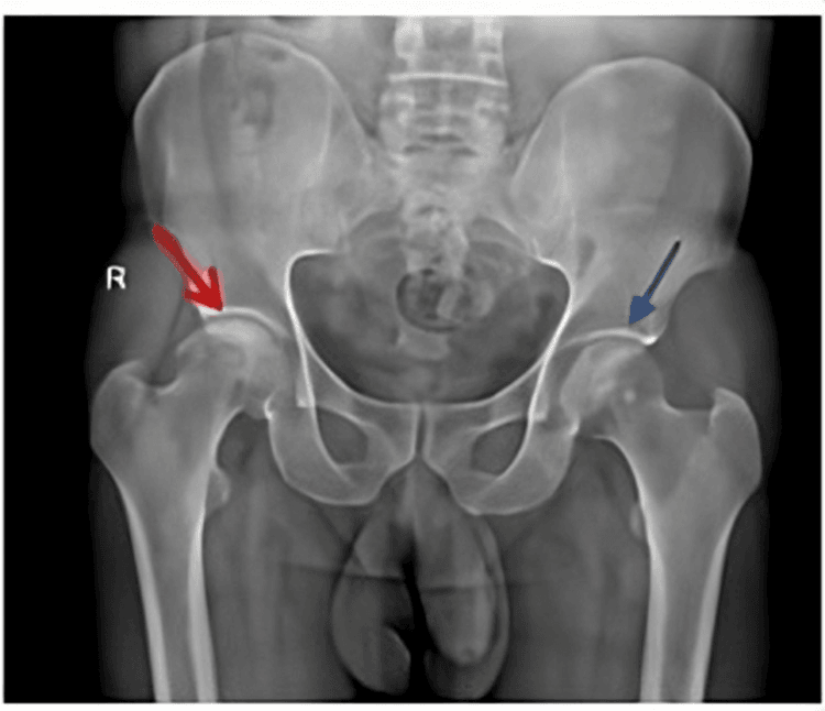 Radiographic comparison of Ficat stage-two and stage-three hip osteonecrosis