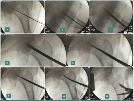 Fluoroscopic core decompression of the femoral head