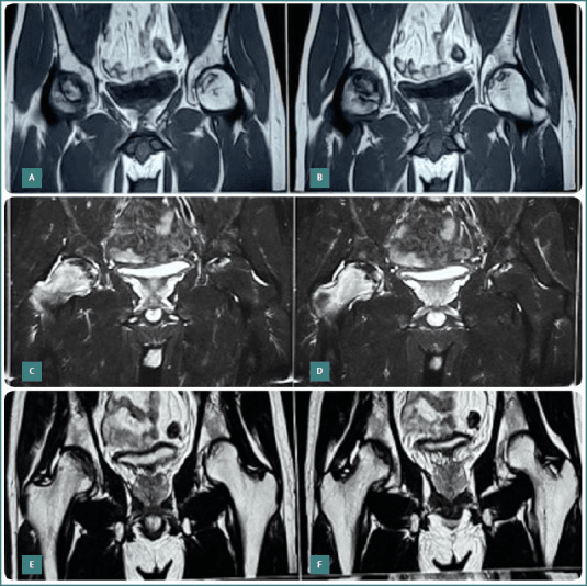 Serial MRI after core decompression and osteoblast implantation for femoral-head osteonecrosis