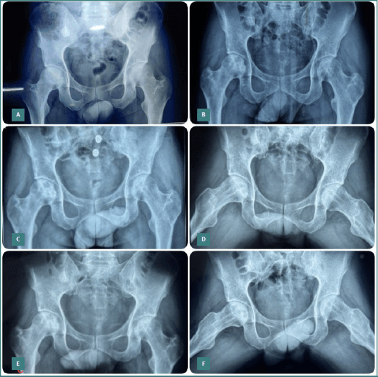Serial radiographs after core decompression for femoral-head osteonecrosis