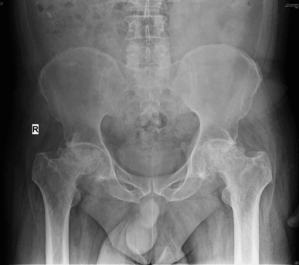 Pelvic radiograph showing femoral-head osteonecrosis in sickle cell disease