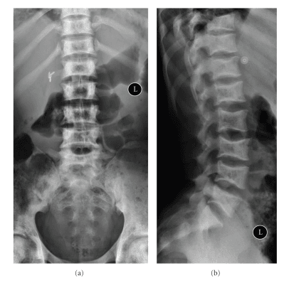 Lumbar radiographs showing H-shaped vertebrae in sickle cell disease