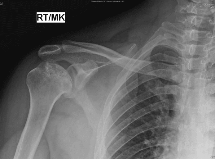 Right shoulder radiograph showing patchy sclerosis of the humeral head from avascular necrosis in sickle cell disease