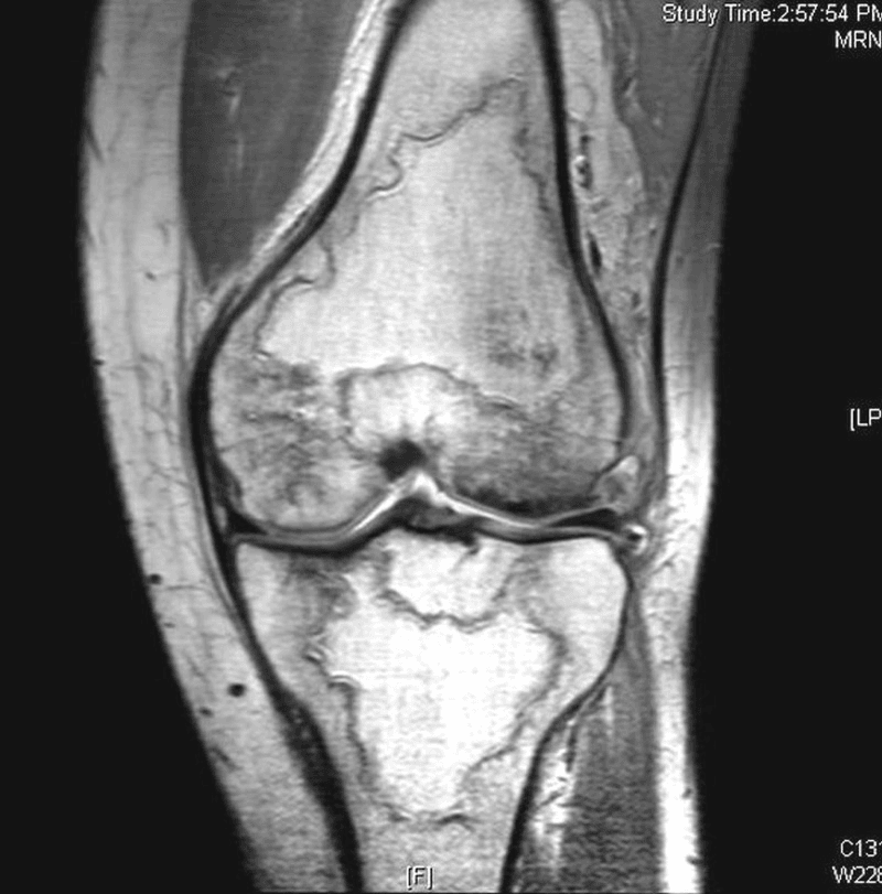 MRI showing multiple medullary infarcts around the knee in sickle cell disease