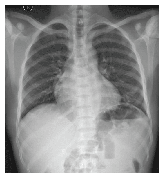 Chest radiograph showing rib changes of marrow expansion in sickle cell disease