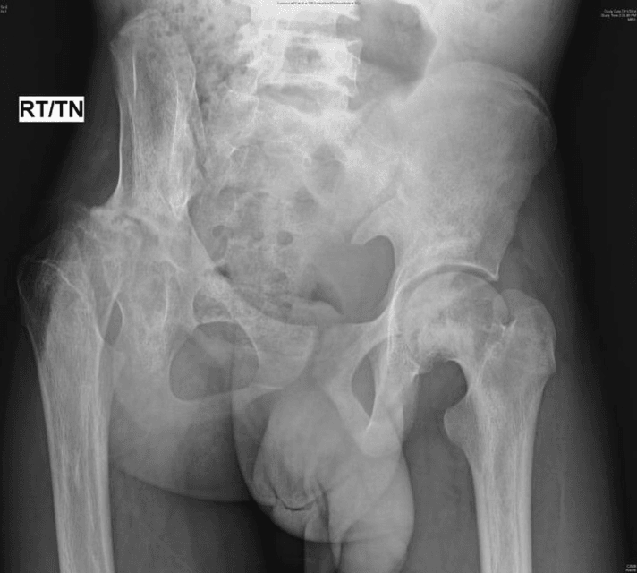 Pelvic radiograph showing proximal femoral growth disturbance in sickle cell disease