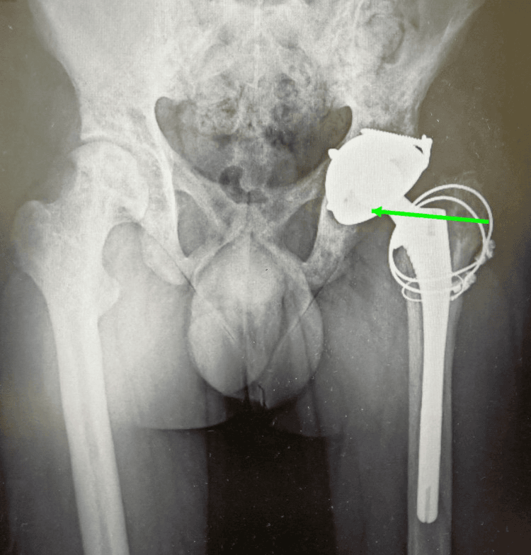 Second-stage total hip arthroplasty after infection control in sickle cell disease