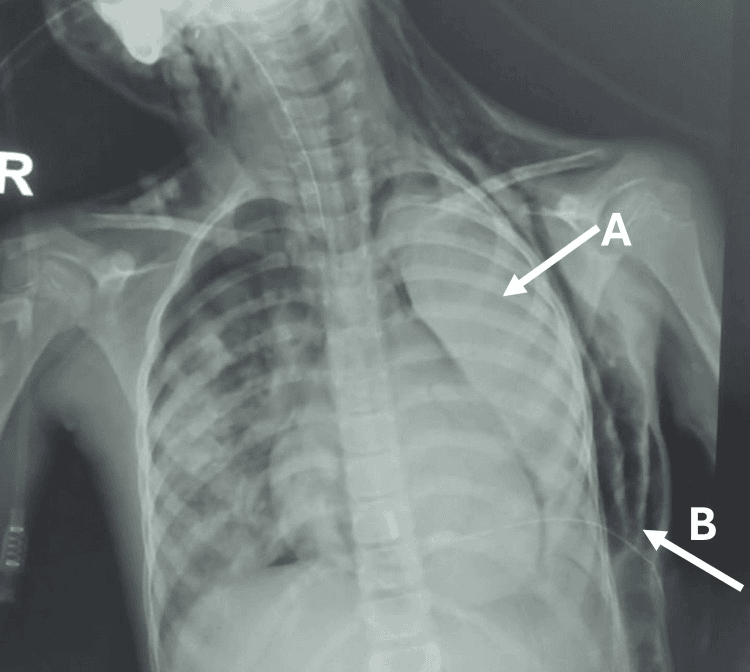 Chest radiograph showing severe acute chest syndrome with left lung collapse