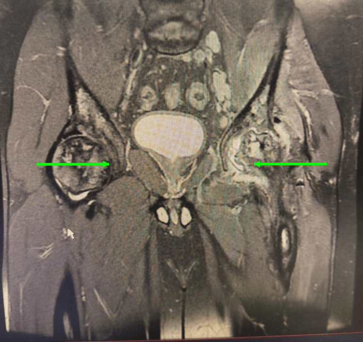 MRI showing osteonecrosis with proximal femoral osteomyelitis septic arthritis and abscess