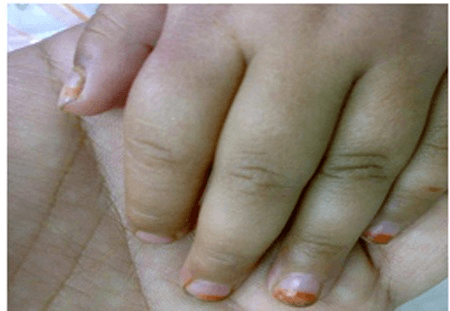 Swollen fingers from sickle-cell dactylitis in a young child