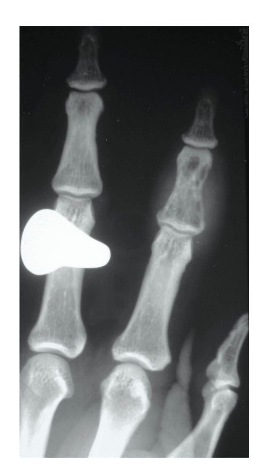 Finger radiograph showing phalangeal osteomyelitis in sickle cell disease