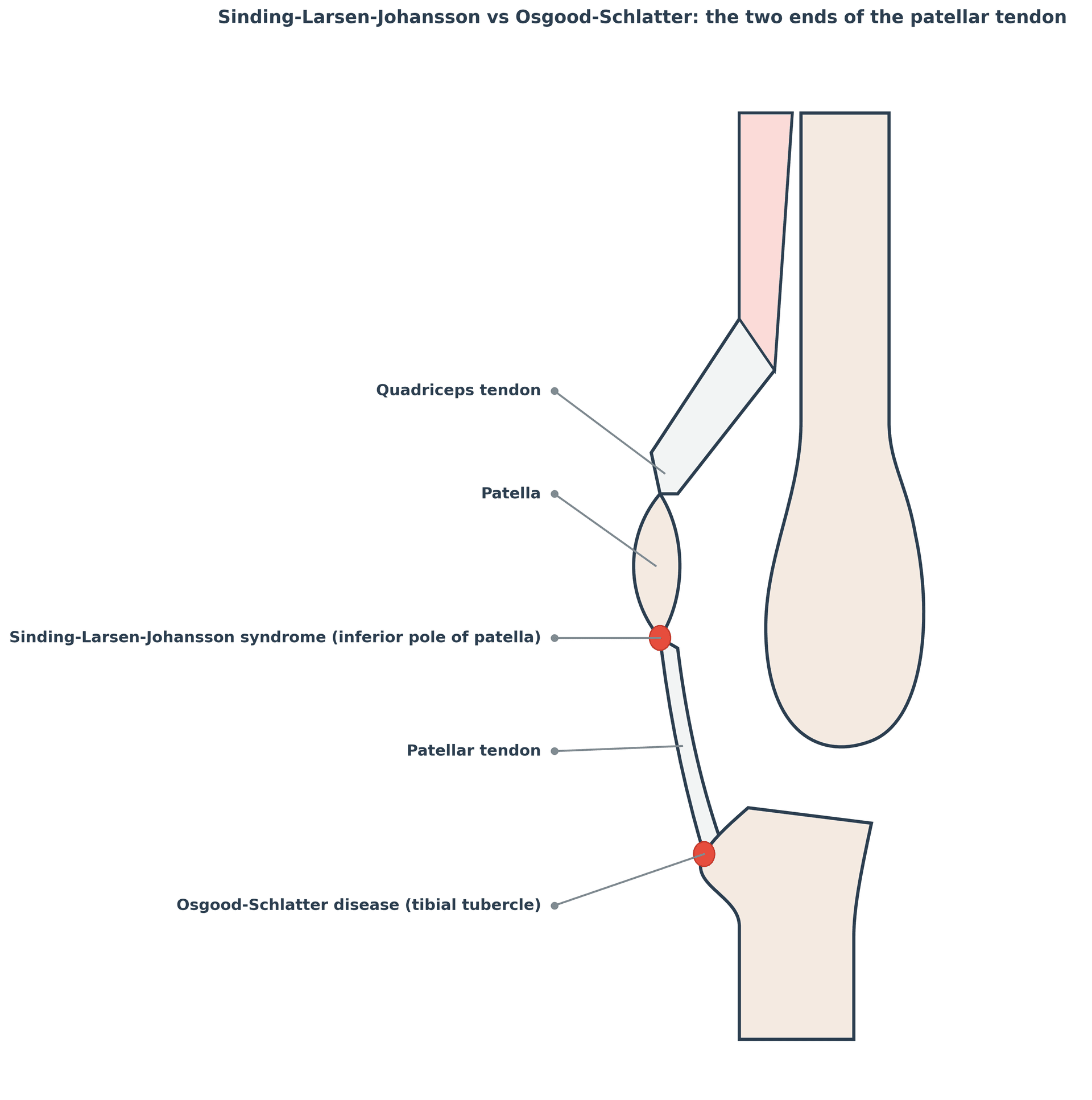 Diagram of the knee extensor mechanism showing Sinding-Larsen-Johansson syndrome at the inferior pole of the patella and Osgood-Schlatter disease at the tibial tubercle