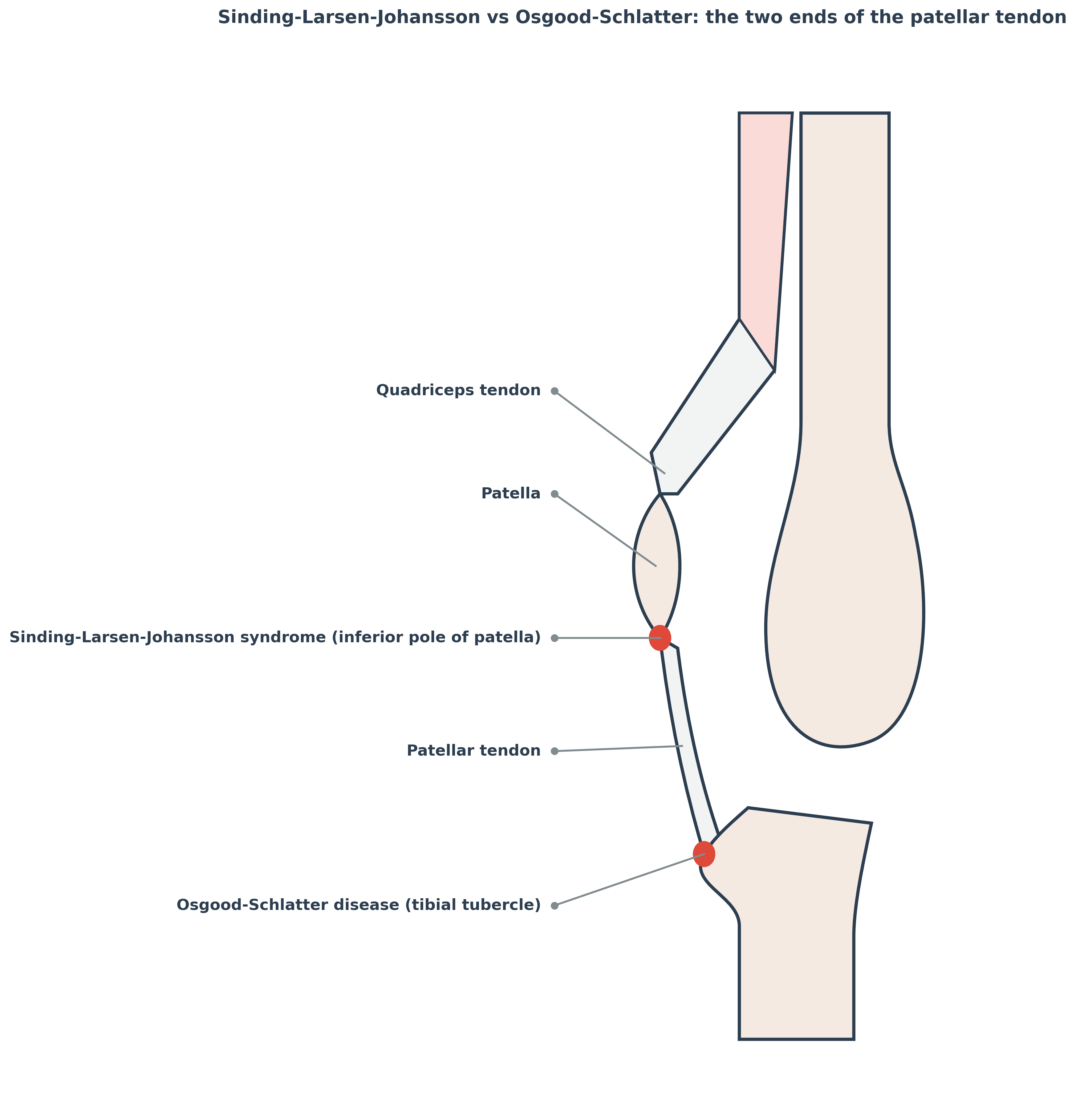 Diagram of the knee extensor mechanism showing Sinding-Larsen-Johansson syndrome at the inferior pole of the patella and Osgood-Schlatter disease at the tibial tubercle