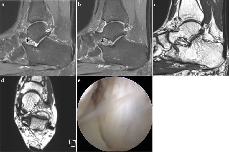 Sagittal T1 and T2 MRI series demonstrating sinus tarsi obliteration in sinus tarsi syndrome