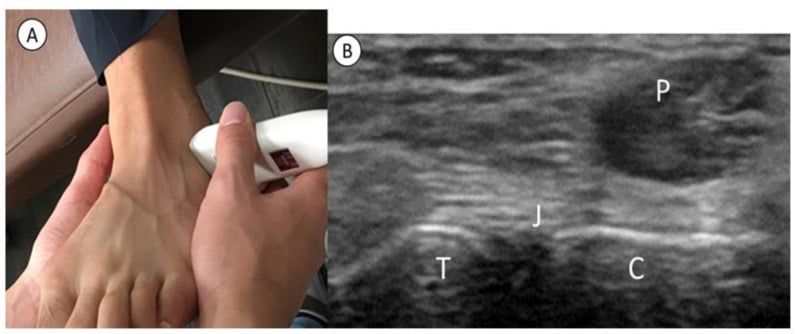 Probe placement and corresponding ultrasound image of the subtalar joint and sinus tarsi