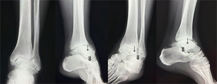 Preoperative radiographs showing end-stage osteoarthritis of the tibiotalar joint