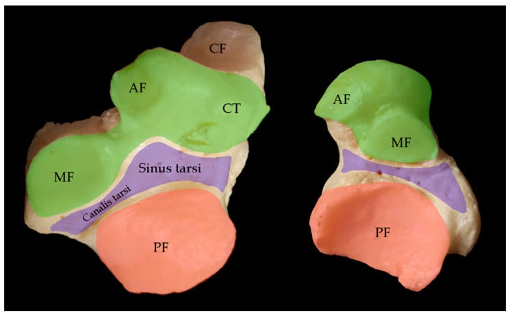 Diagram of the articular facets of the subtalar joint complex showing the sinus tarsi canal