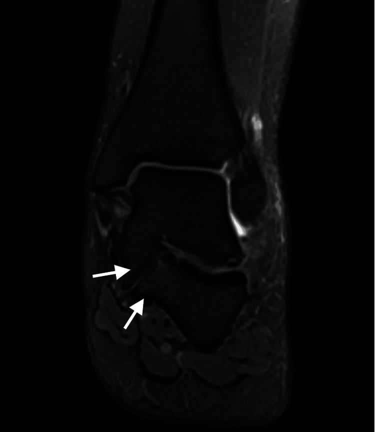 Coronal MRI showing a type 3 talocalcaneal coalition with fusion of the sustentaculum tali