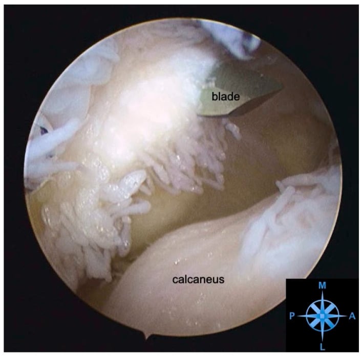 Arthroscopic view of the subtalar joint showing severe synovitis prior to debridement