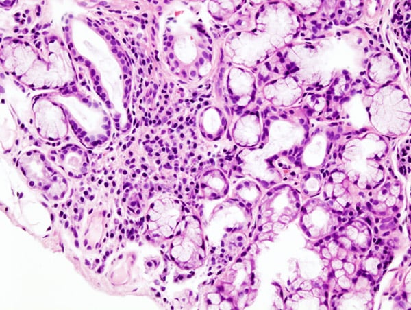 Histology of a labial salivary gland biopsy showing a focal lymphocytic infiltrate in Sjogren syndrome