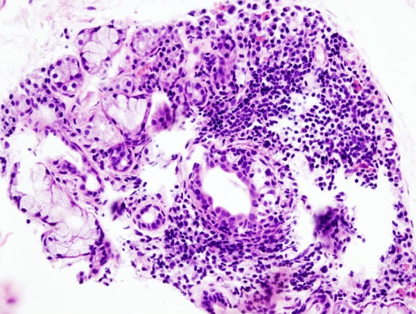 Histology of a labial salivary gland biopsy showing focal lymphoplasmacytic infiltration in Sjogren syndrome