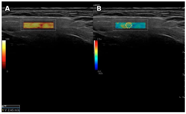 B-mode ultrasound and shear-wave elastography images of the parotid gland in Sjögren's syndrome