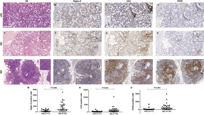 Minor salivary gland labial biopsy H&E histology and immunohistochemistry showing focal lymphocytic sialadenitis