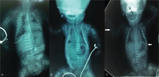 Neonatal babygram radiographs of severe skeletal dysplasia.