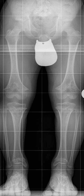 Standing lower-limb radiograph in achondroplasia showing bowed legs.